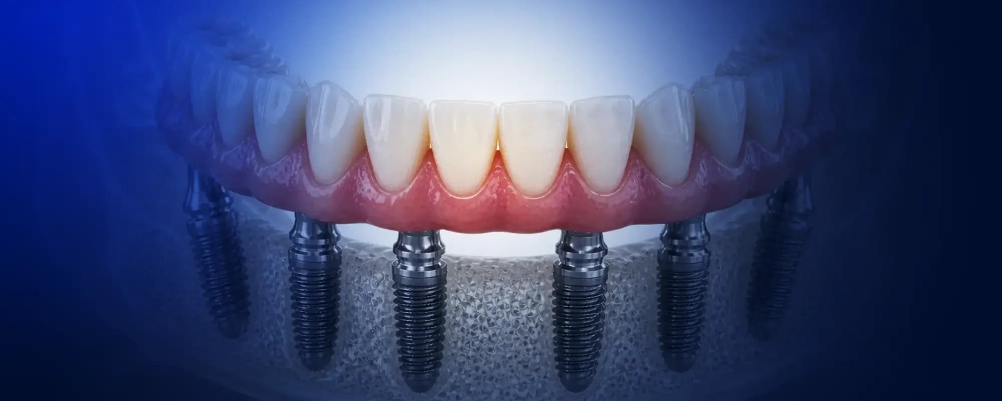 Chto takoe dentalnyi implantat All-on-4 v Turcii?