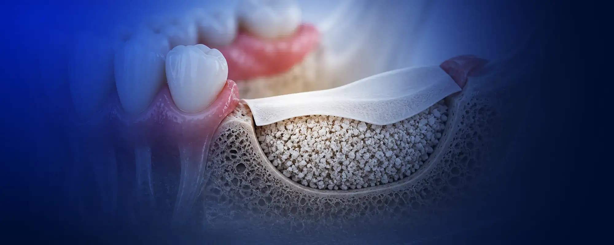 Sicherer Knochenaufbau für planbare Implantate