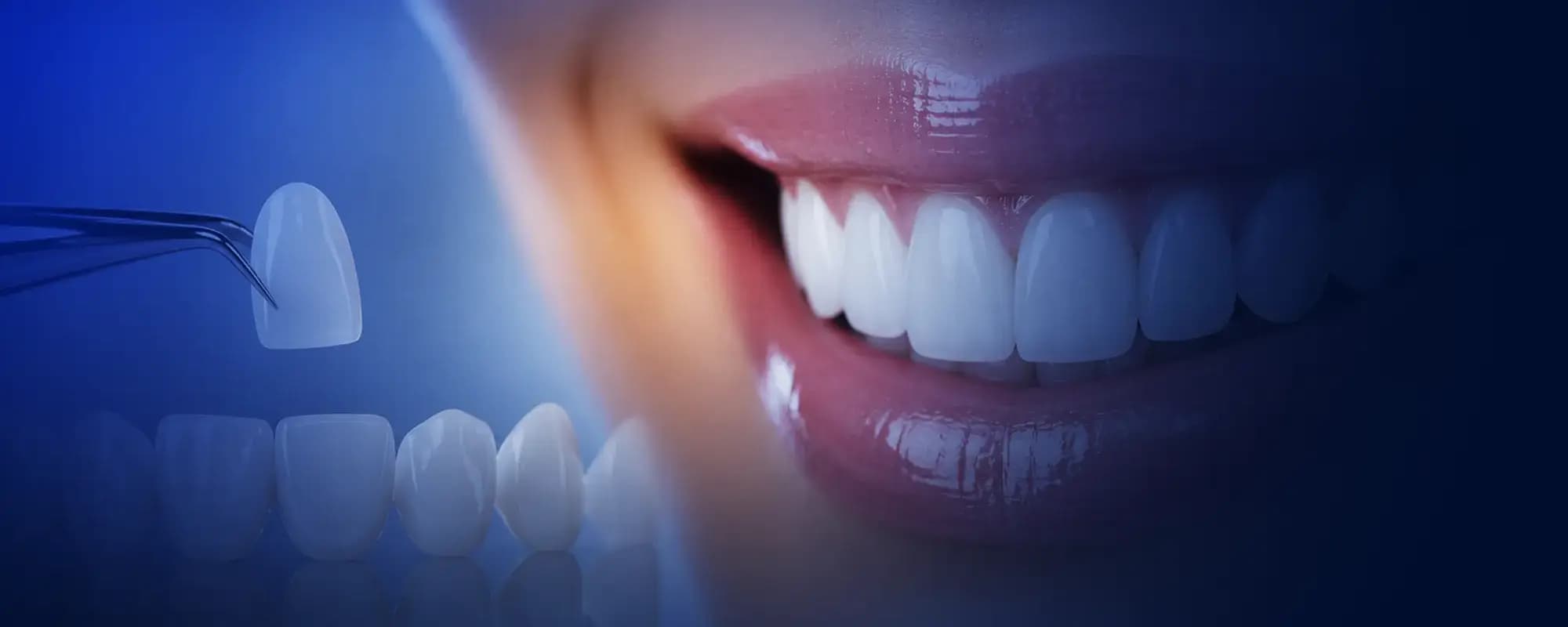 Yüze uyumlu premium Hollywood Smile tasarımı