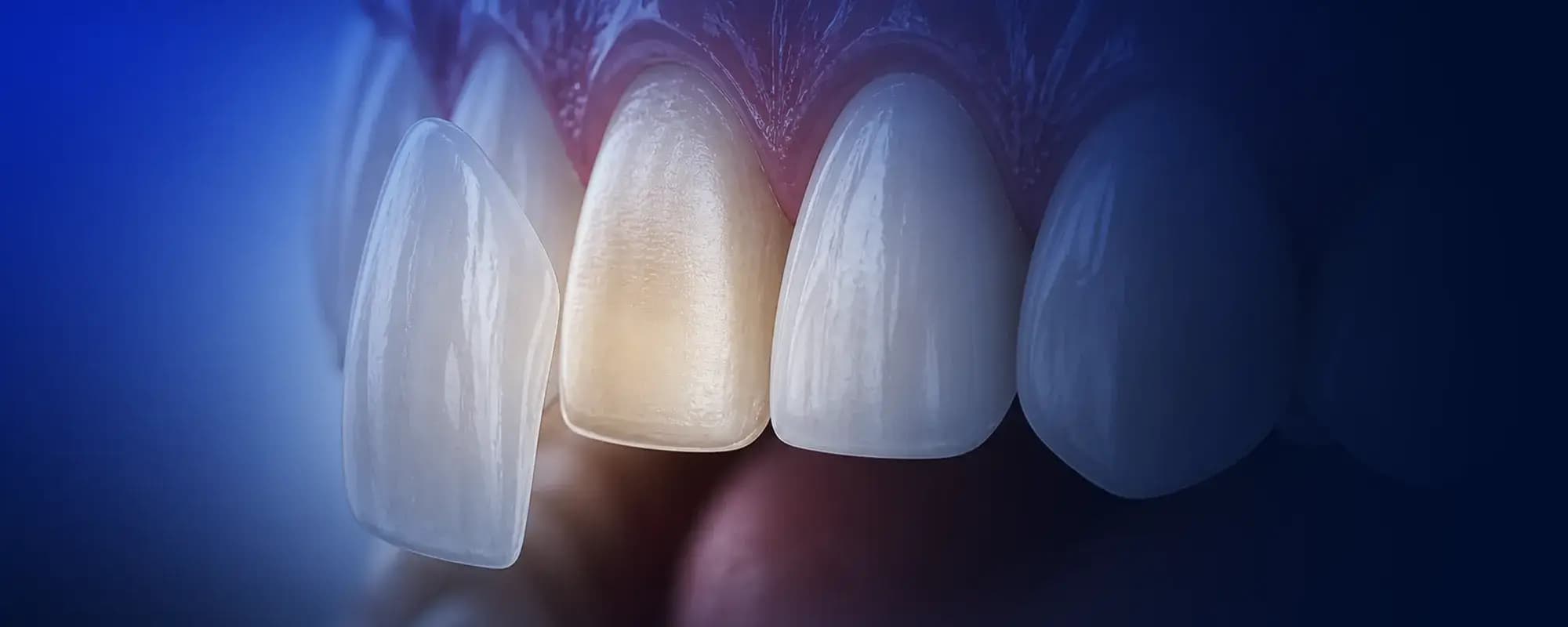 Minimal dokunuşla doğal lamina veneer gülüşü