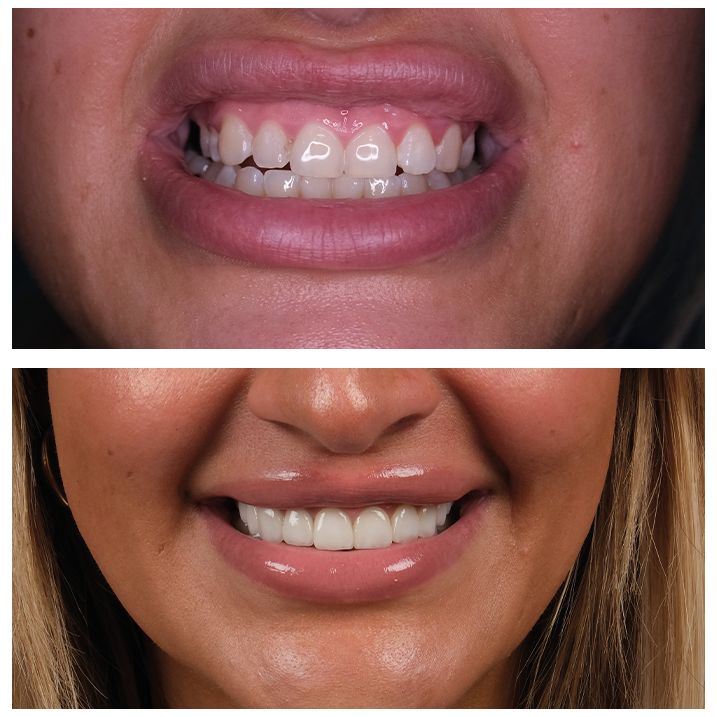Before After 1
