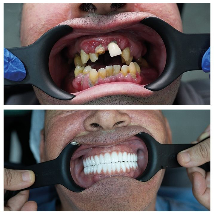 Before After 2