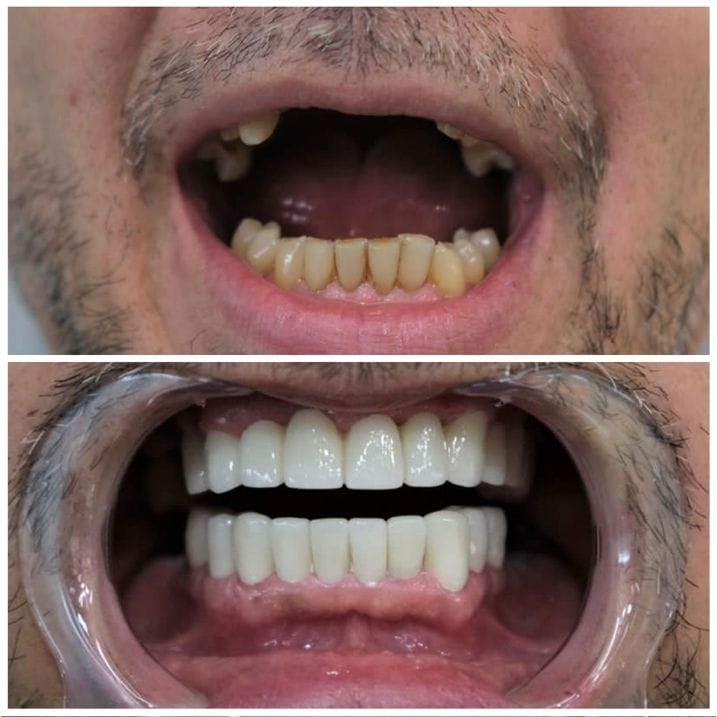 Before After 5