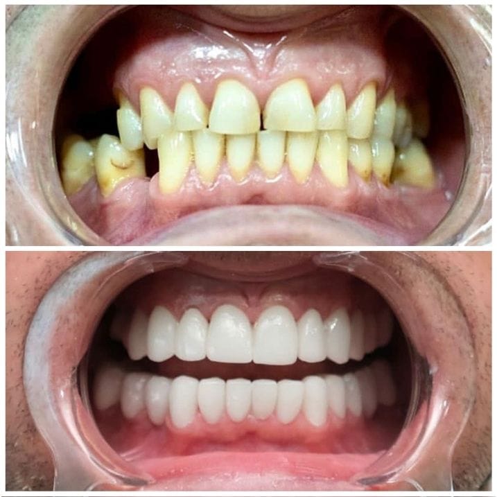 Before After 3