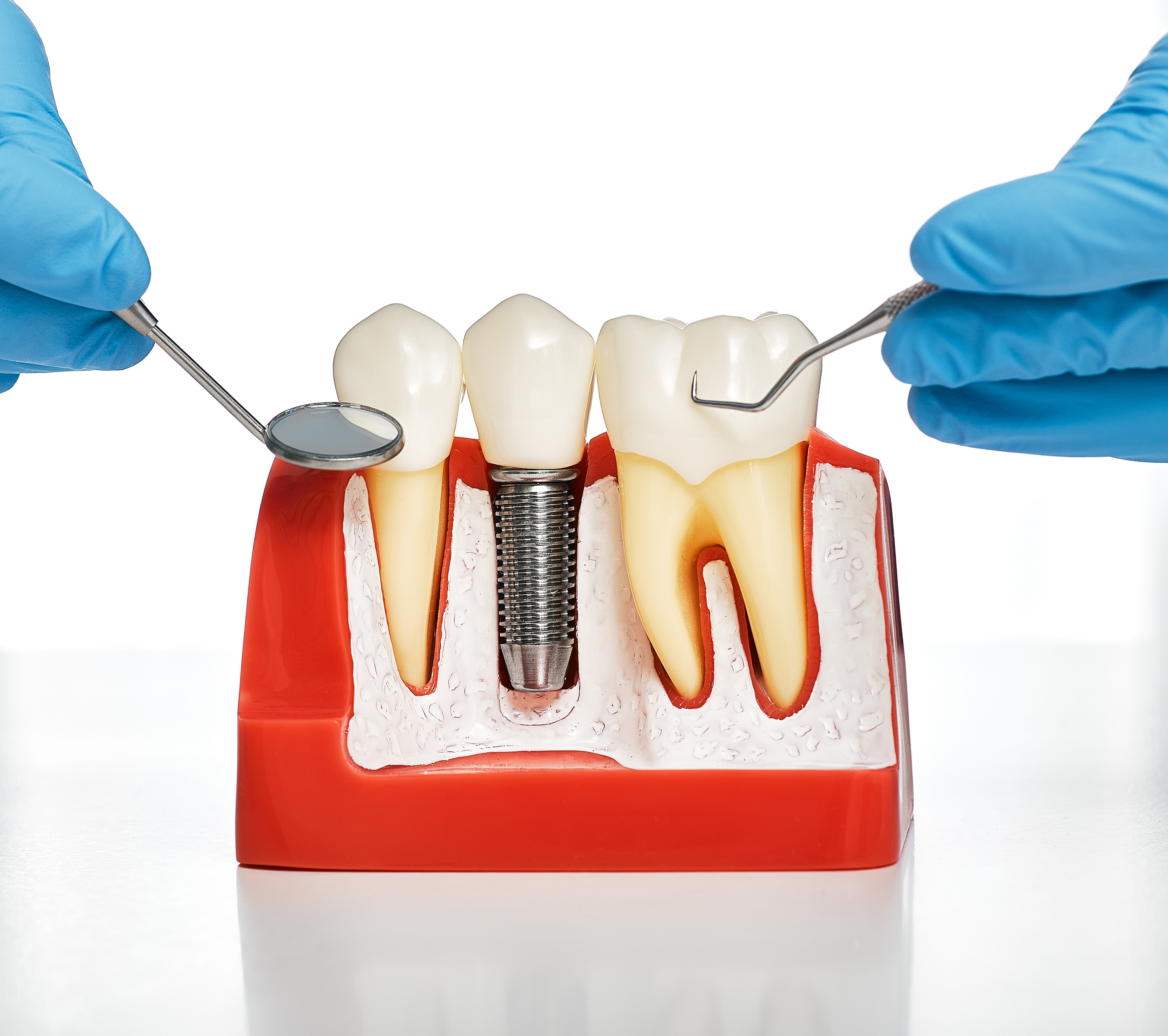 Veneers Detail